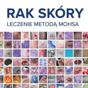 Rak skóry Leczenie metodą Mohsa
