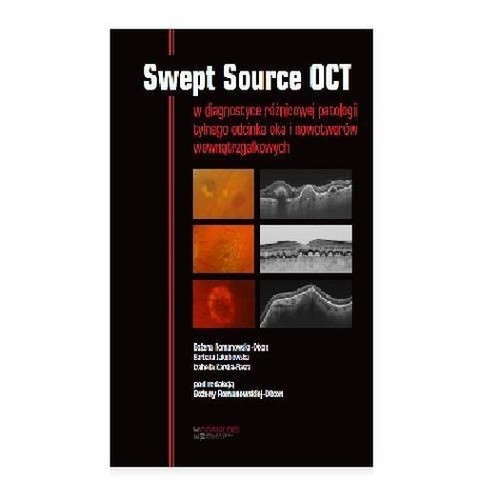Swept Source OCT w diagnostyce patologii tylne